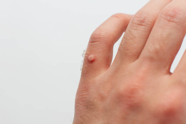 What Vitamin Deficiency Causes Warts